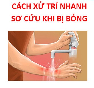 Cách xử trí nhanh sơ cứu khi bị bỏng