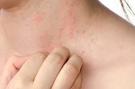 Các bệnh về da ở trẻ em thường gặp và cách phòng tránh