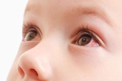Đau mắt đỏ: Nguyên nhân, triệu chứng và cách phòng ngừa bệnh đau mắt đỏ